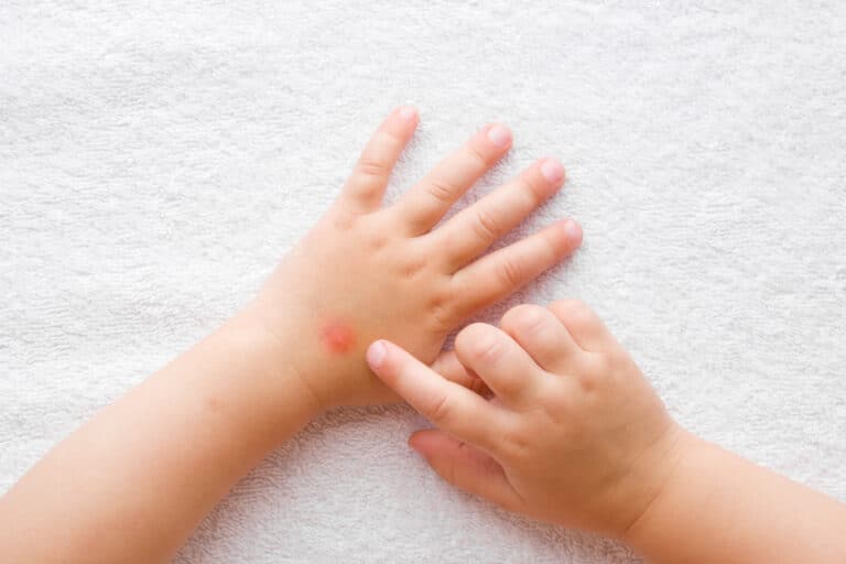 Homéopathie : la trousse naturelle indispensable de l’été